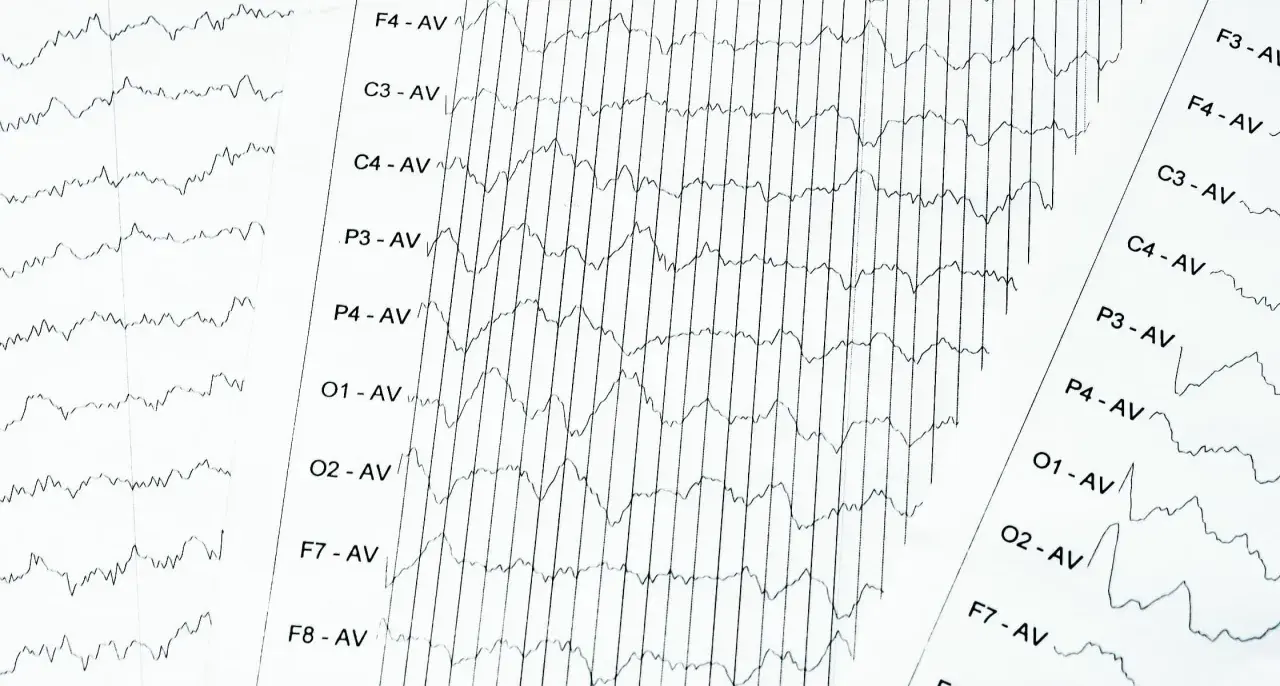 EEG-Aufzeichnung mit Wellenmustern, die auf ADHS hindeuten könnten. Die Linien zeigen Gehirnaktivität.