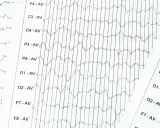 EEG-Aufzeichnung mit Wellenmustern, die auf ADHS hindeuten könnten. Die Linien zeigen Gehirnaktivität.
