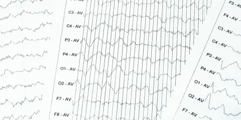 EEG-Aufzeichnung mit Wellenmustern, die auf ADHS hindeuten könnten. Die Linien zeigen Gehirnaktivität.