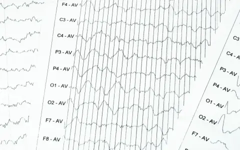 EEG-Aufzeichnung mit Wellenmustern, die auf ADHS hindeuten könnten. Die Linien zeigen Gehirnaktivität.